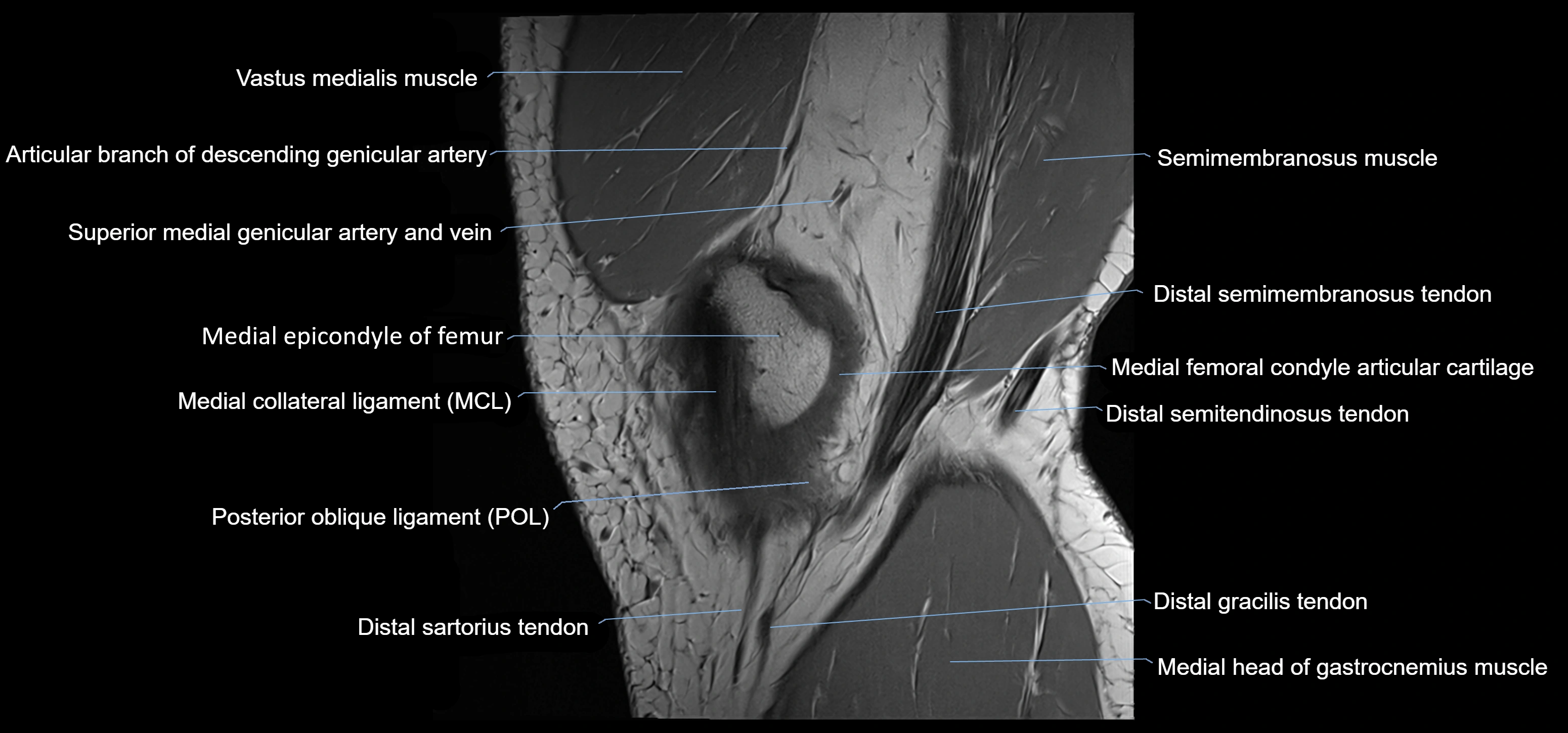 MRI knee sagittal cross sectional anatomy labelled 3T radiology image-00009.webp